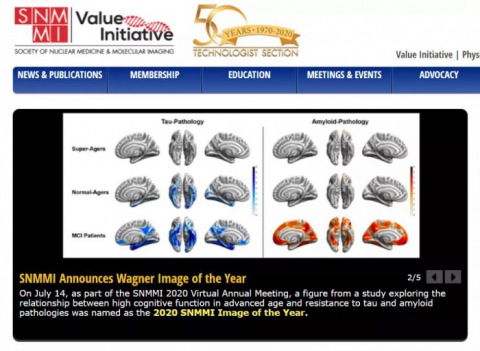 “超級老人”的大腦為何能抵禦阿爾茨海默（mò）病